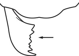 Close-up view of mandibles, adult worker. The mandibles with seven teeth and denticles. Used in Antkey to separate  Pachycondyla chinensis  from  Pachycondyla stigma  and  Hypoponera  species.
