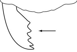 Close-up view of mandibles, adult worker. Mandibles with five teeth and denticles. Used in Antkey to separate  Pachycondyla stigma  from  Pachycondyla chinensis  and  Hypoponera  species.