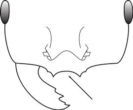Anterior view of clypeus, adult worker. The anterior margin of the clypeus has two distinct lateral teeth that straddle the midline, but is missing a distinct median tooth between them. Used in Antkey to separate  Solenopsis geminata  and  Solenopsis xyloni  from  Solenopsis invicta  and  Solenopsis richteri . This is arguably the most useful character for separating these species, but it can be difficult to see in some specimens.